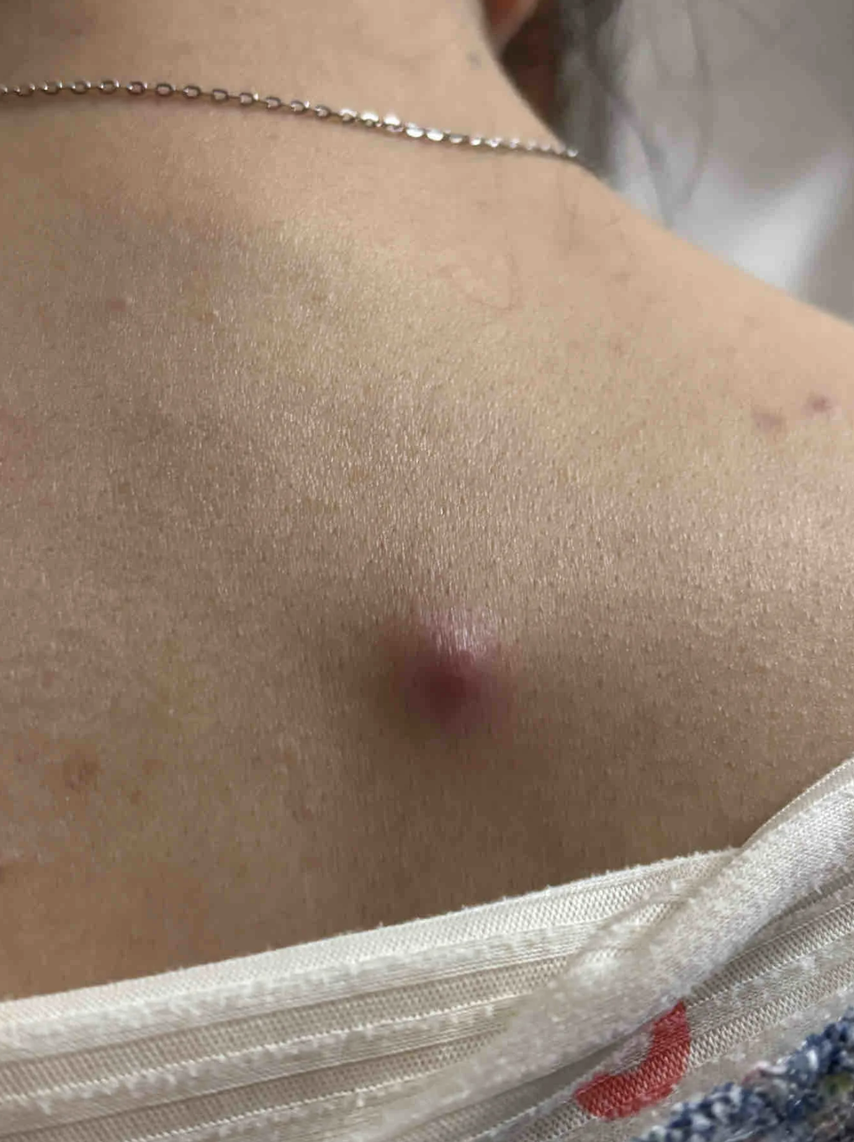 后背长了个红肿疼痛的痘痘,最常见的原因是毛囊炎,疖肿或带状疱疹