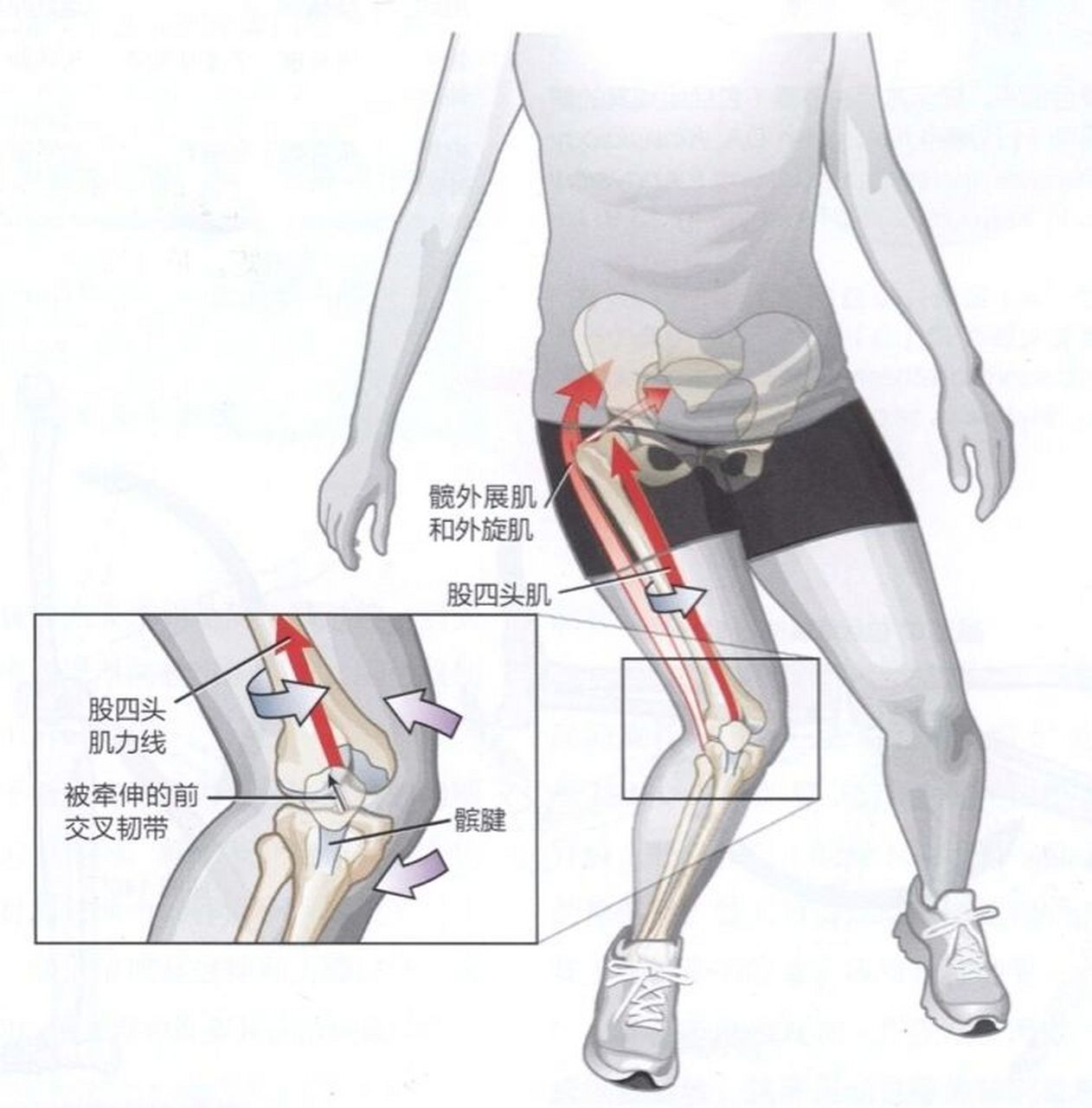 损伤康复(前交叉韧带损伤的常见机制)  	 前交叉韧带是最常发生完全
