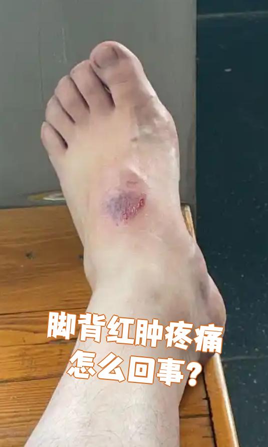 脚背红肿疼痛常见原因有扭伤,感染或痛风等