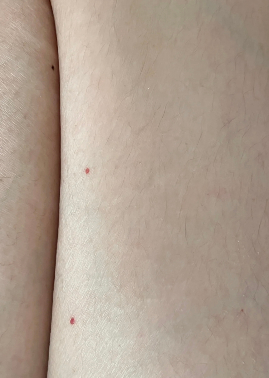 如果是血管痣,通常表现为针尖大小的红点,突出在皮肤表面