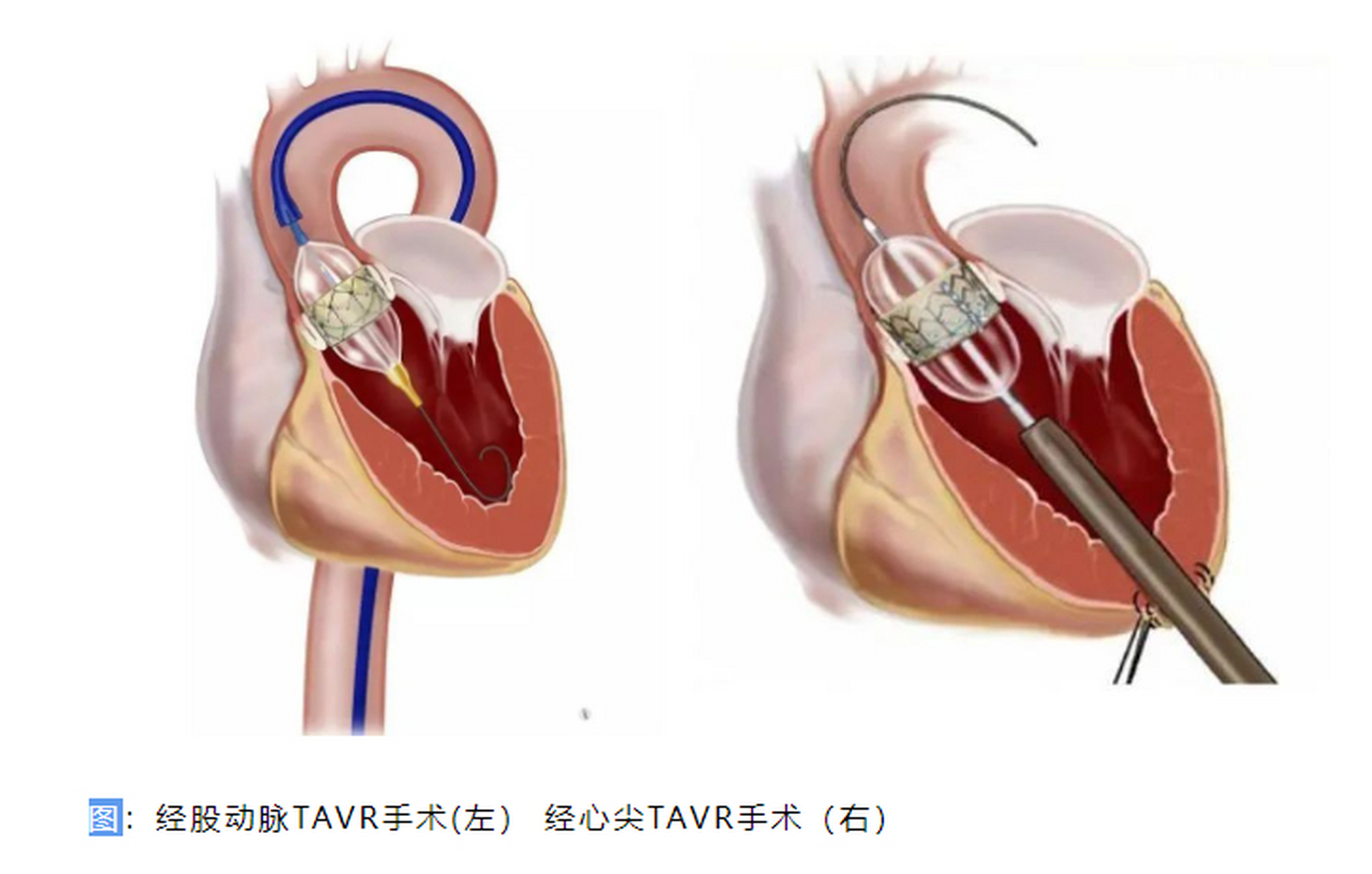 换心脏图片图片