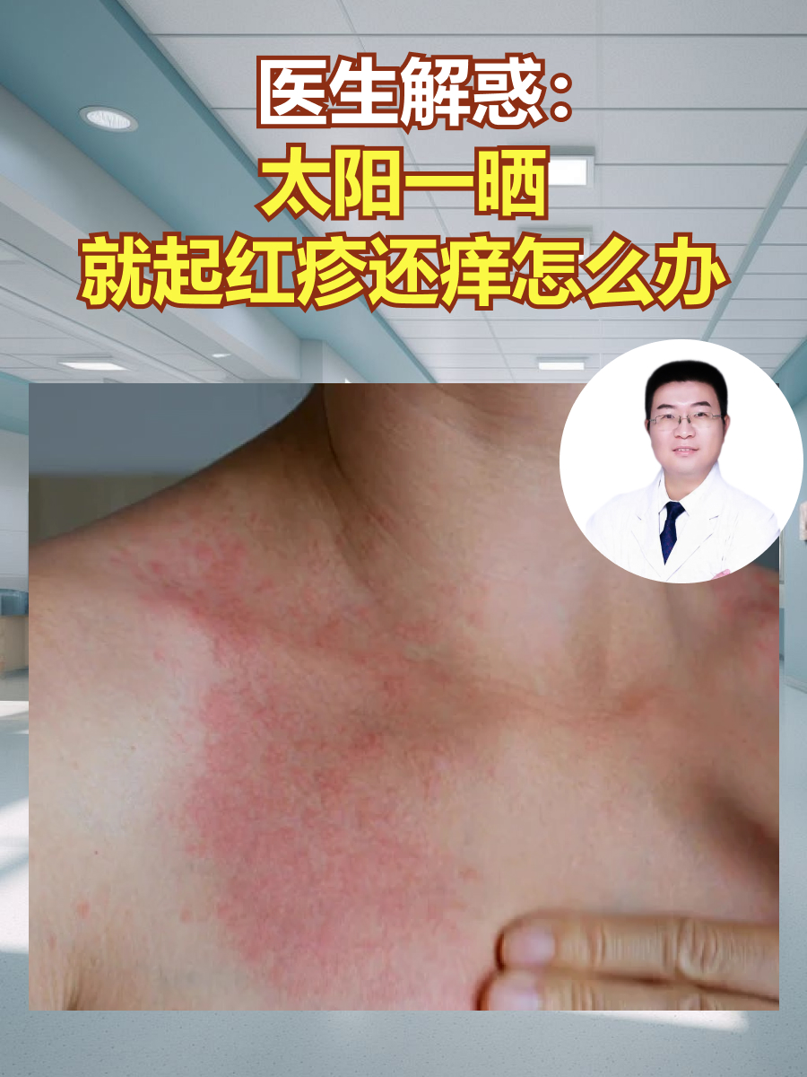 下面是关于太阳一晒就起红疹还痒的原因: 日光性皮