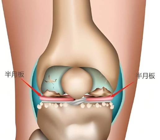 半月板内侧后角是膝关节内侧半月板靠后的部分