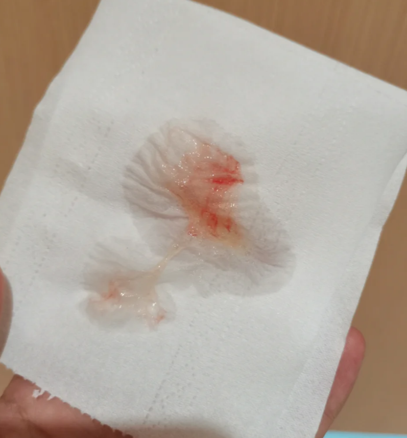 咳嗽带血丝可能由多种疾病引起,常见原因包括肺结核,支气管炎,支