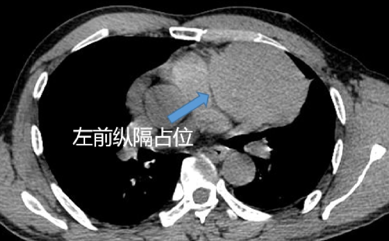 胸腺瘤(a型) 左前中上纵隔见一类圆形软组织密度肿物影,边界清,局部浅