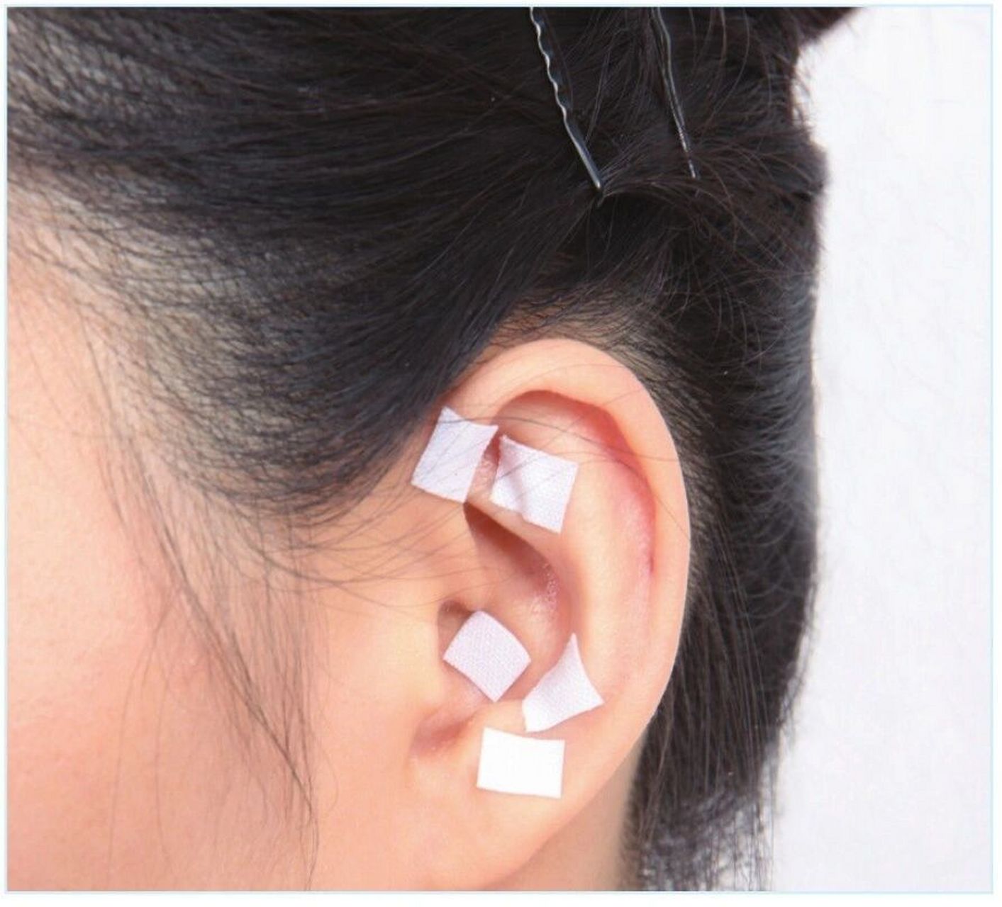 耳穴压豆,王不留行籽,眼睛视力