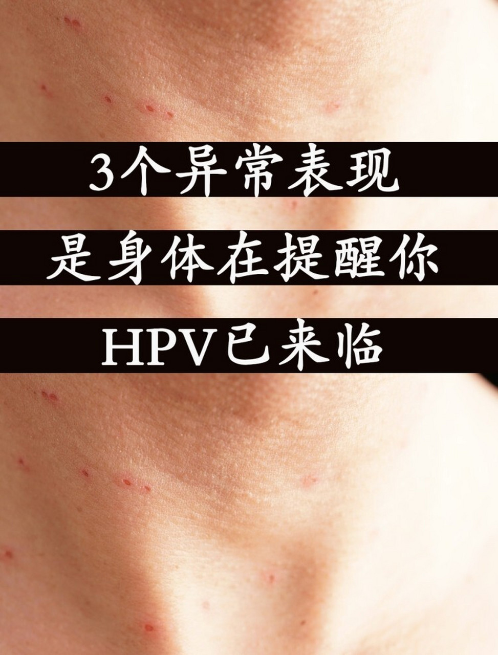 hpv有什么表现症状hvp图片