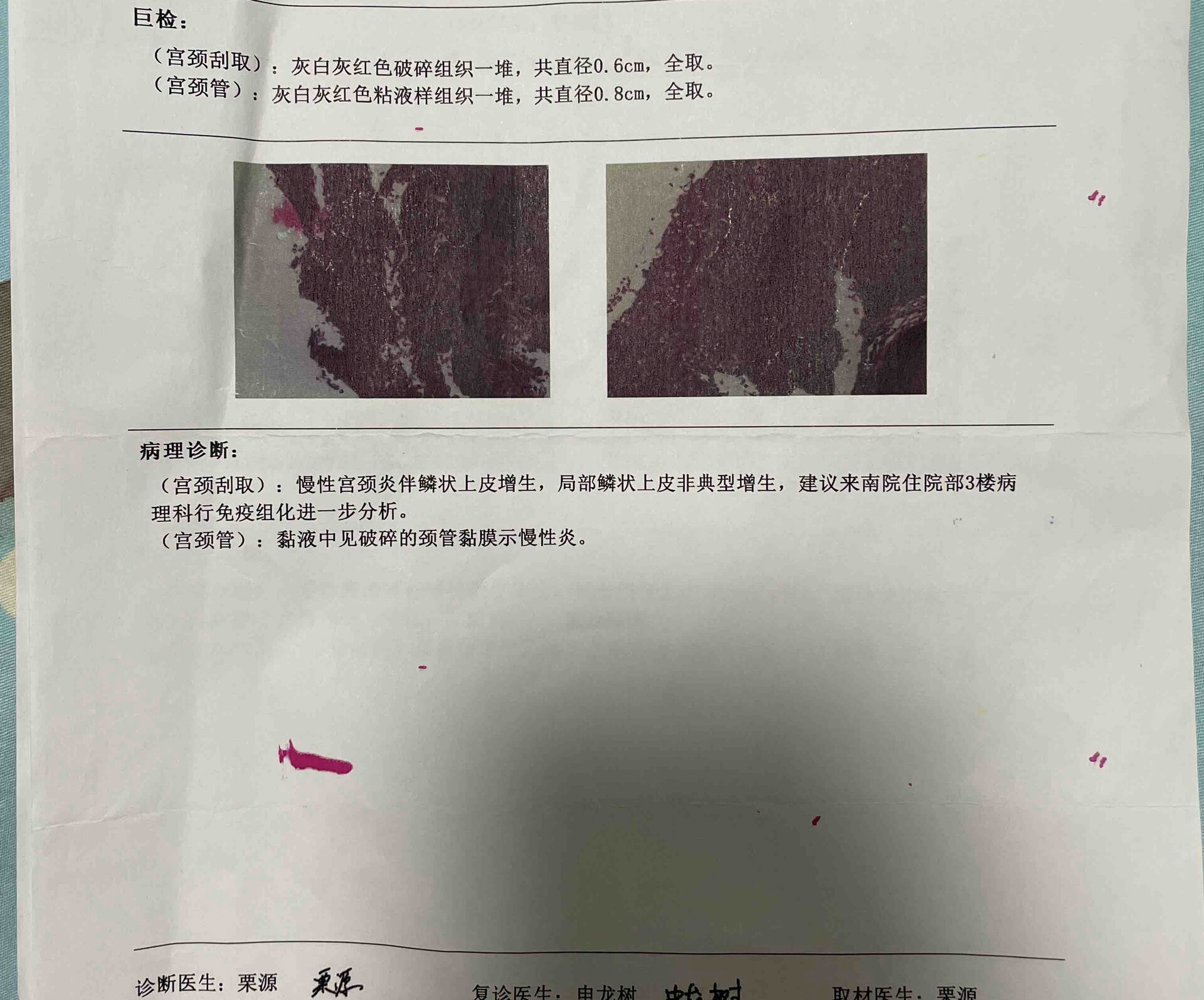 宫颈病变并不可怕,相信自己 2月17号的活检结果建议做免疫组化,免疫组