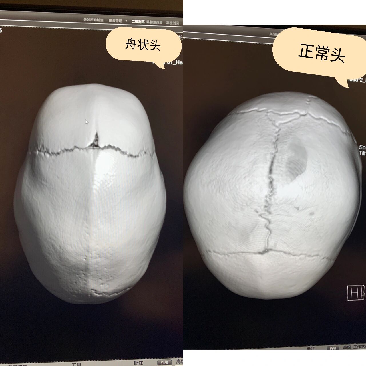 婴幼儿头型不正,是睡扁了还是颅缝早闭?