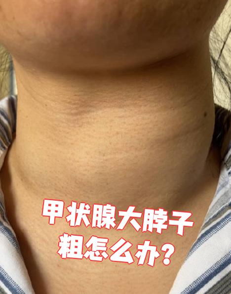 甲状腺大,脖子粗可能和甲状腺功能亢进症,甲状腺炎,结节性甲状腺肿