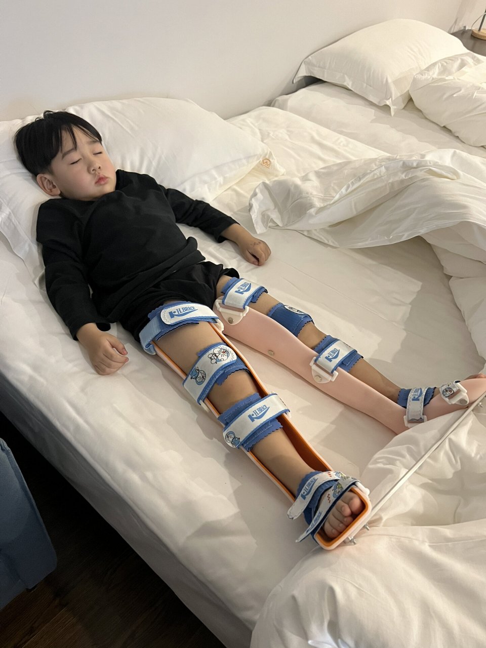 3岁多儿童x腿 膝外翻治疗矫正支具 还是要到儿童医院来做  医生非常