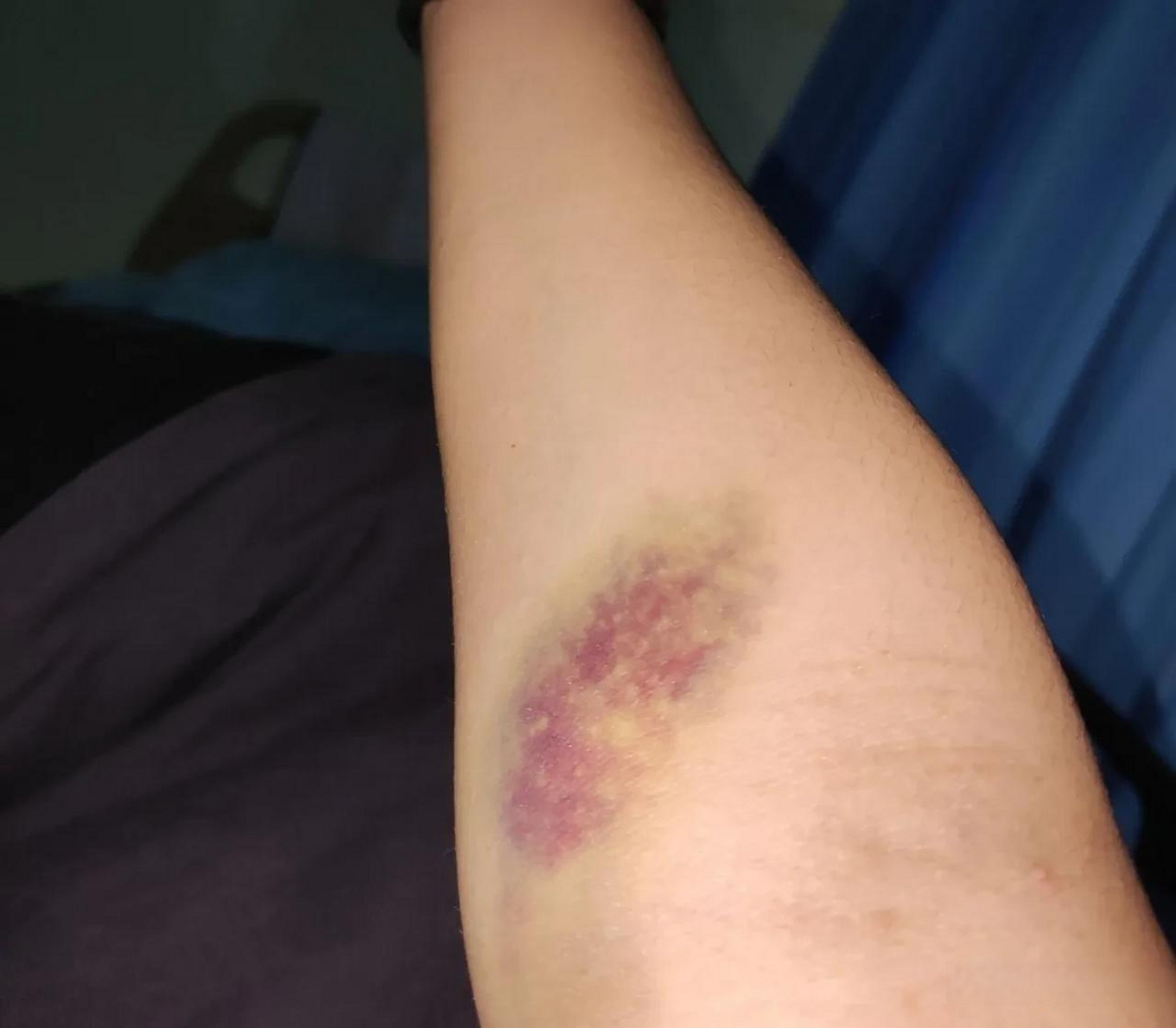 女子20元拔罐除湿拔出黑紫色拔罐的时候,毛细血管破裂,毛细血管网里有
