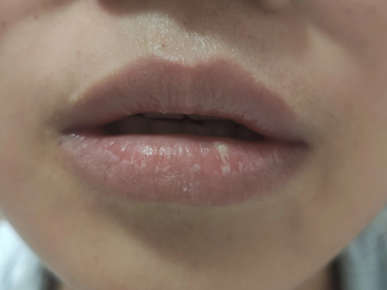 唇膏唇炎(唇膏唇炎专用) 唇膏唇炎(唇膏唇炎专用)