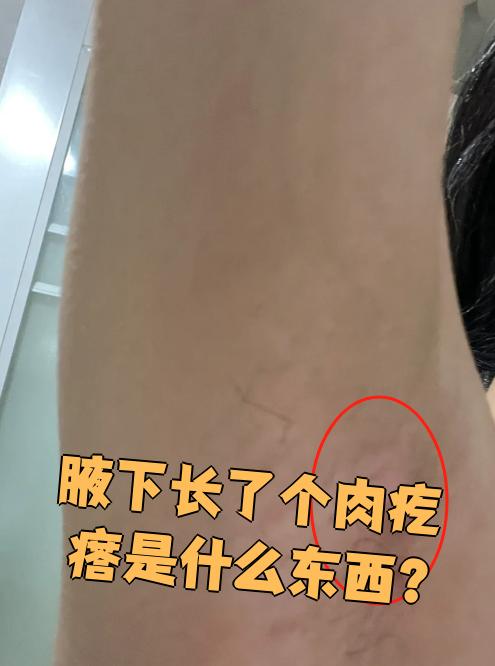 腋窝里突然摸到个肉疙瘩,先别慌