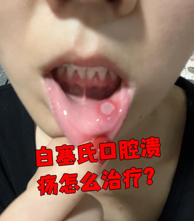 白塞氏口腔溃疡的治疗方法包括药物和手术