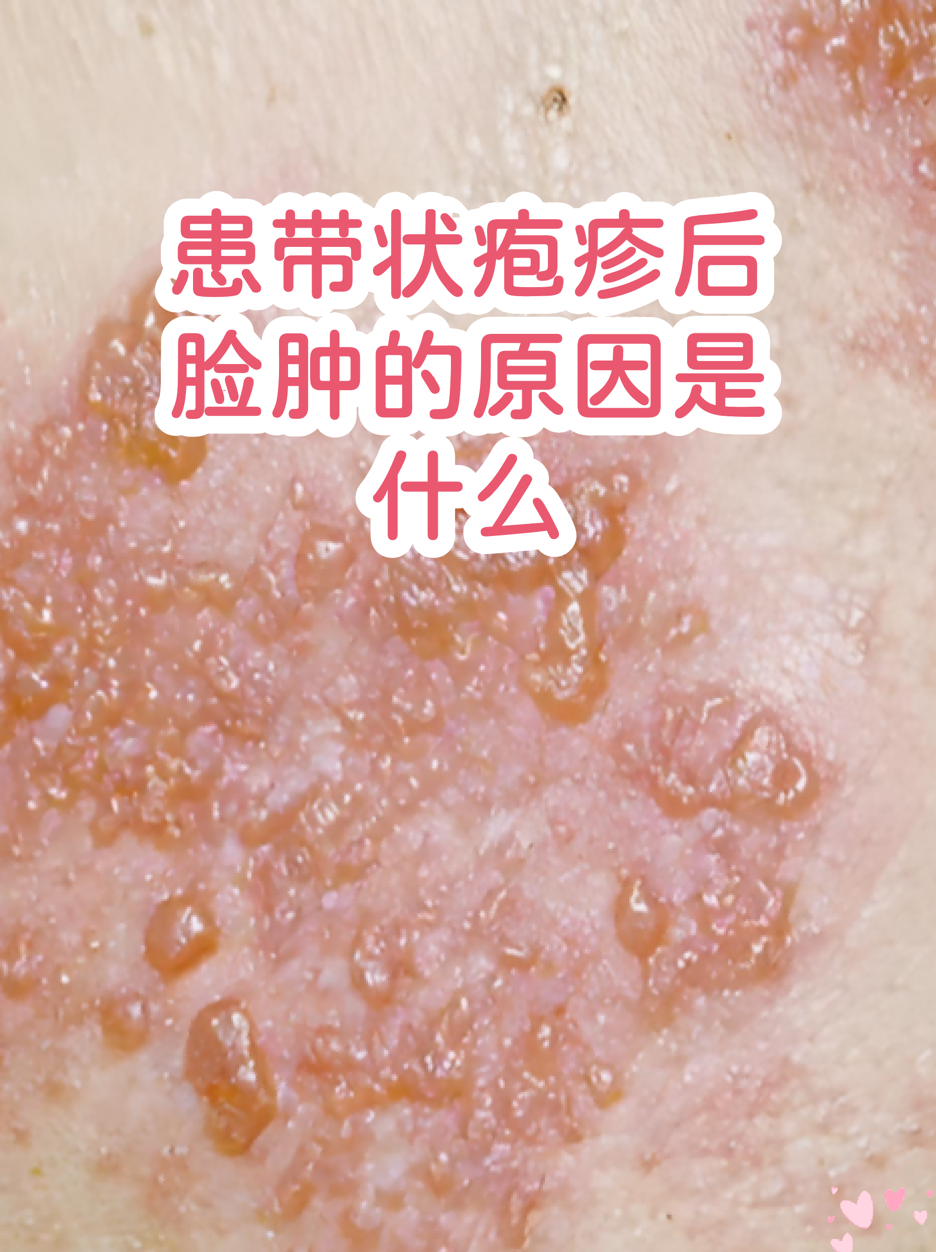  带状疱疹是什么病毒引起的原因(初期疱疹图片)