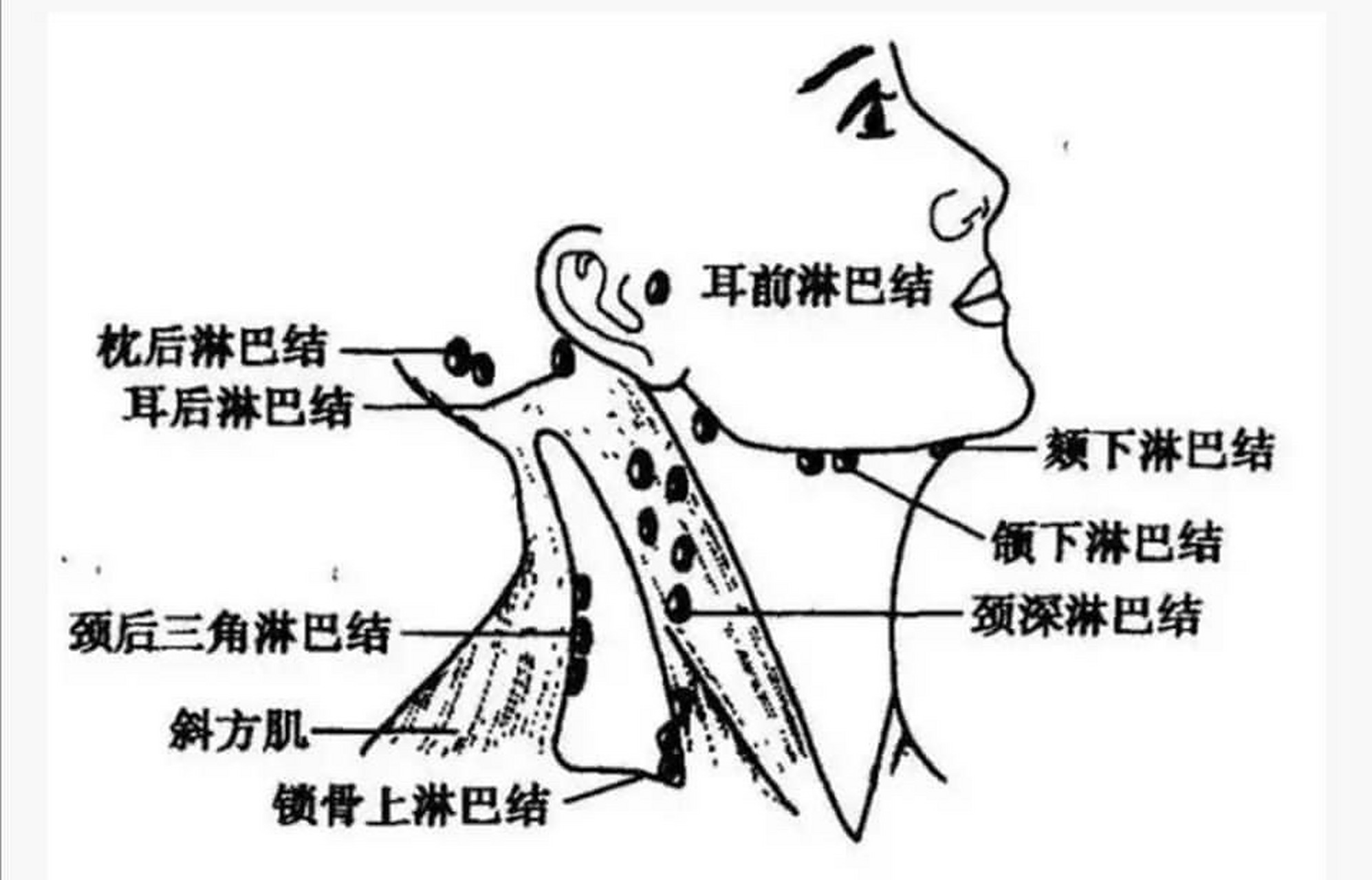 1,淋巴是人体最后一道防御系统,也是人体垃圾回收站,是人体的清洁工
