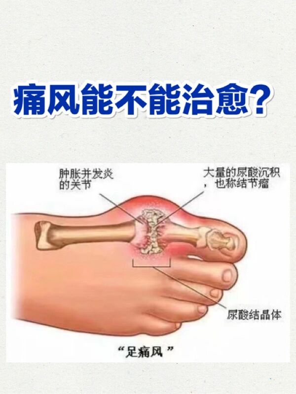 痛风能彻底治愈吗图片