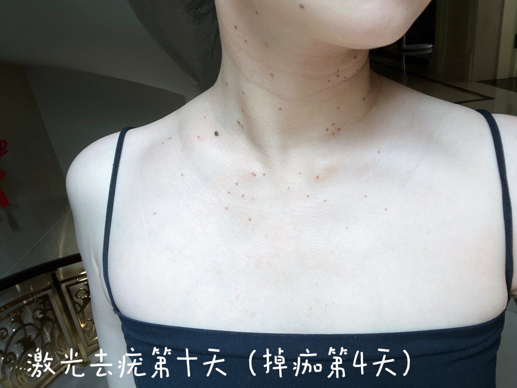 激光去疣第十天(开始掉痂第4天) 终于激光处完全不红了,其实这种时候