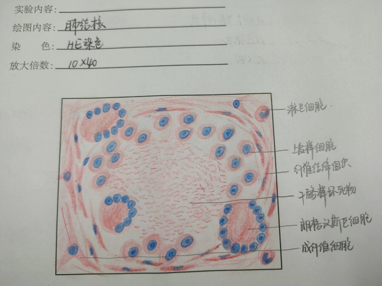 小叶性肺炎绘图图片