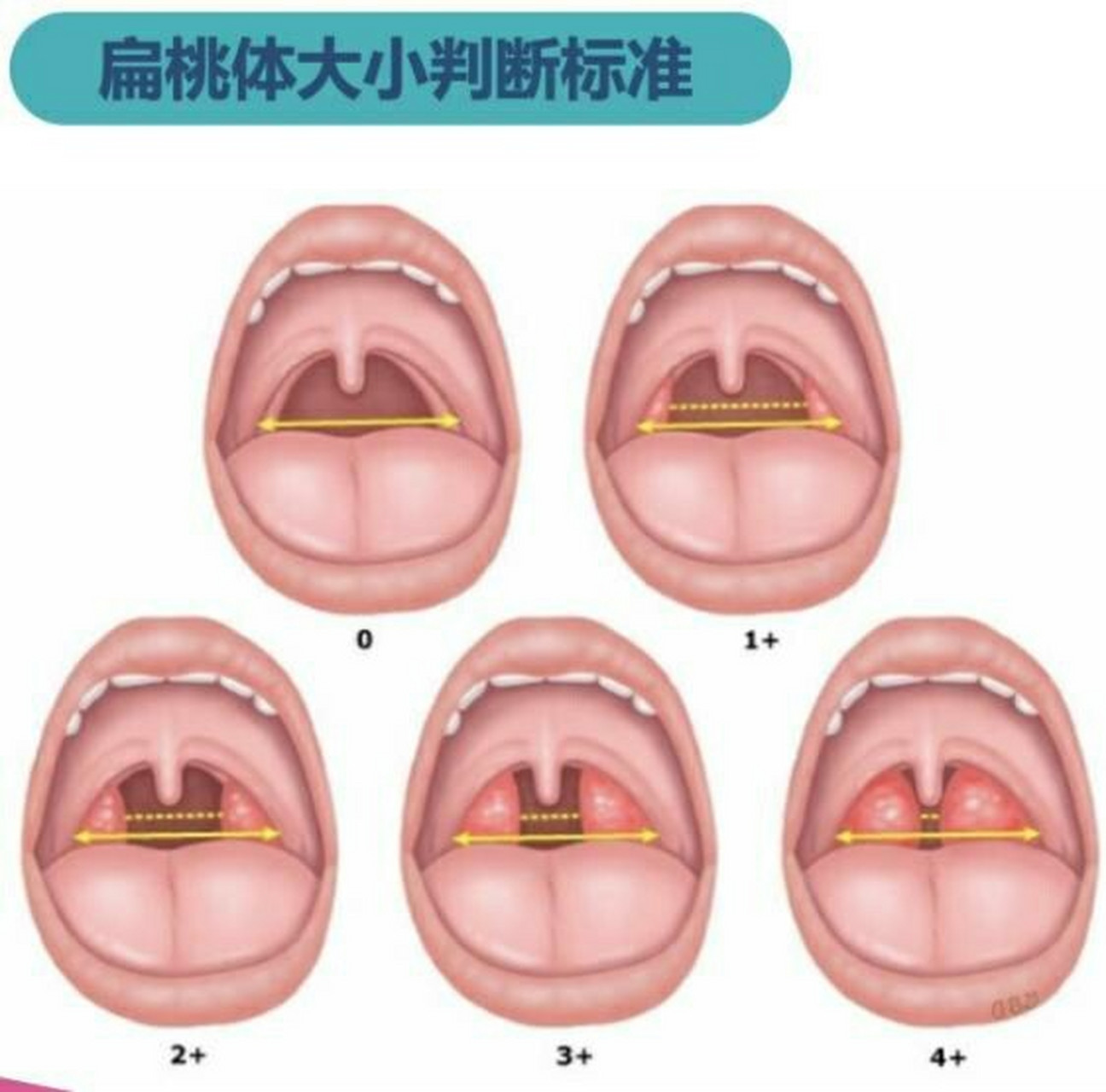 宝宝扁桃体正常图片