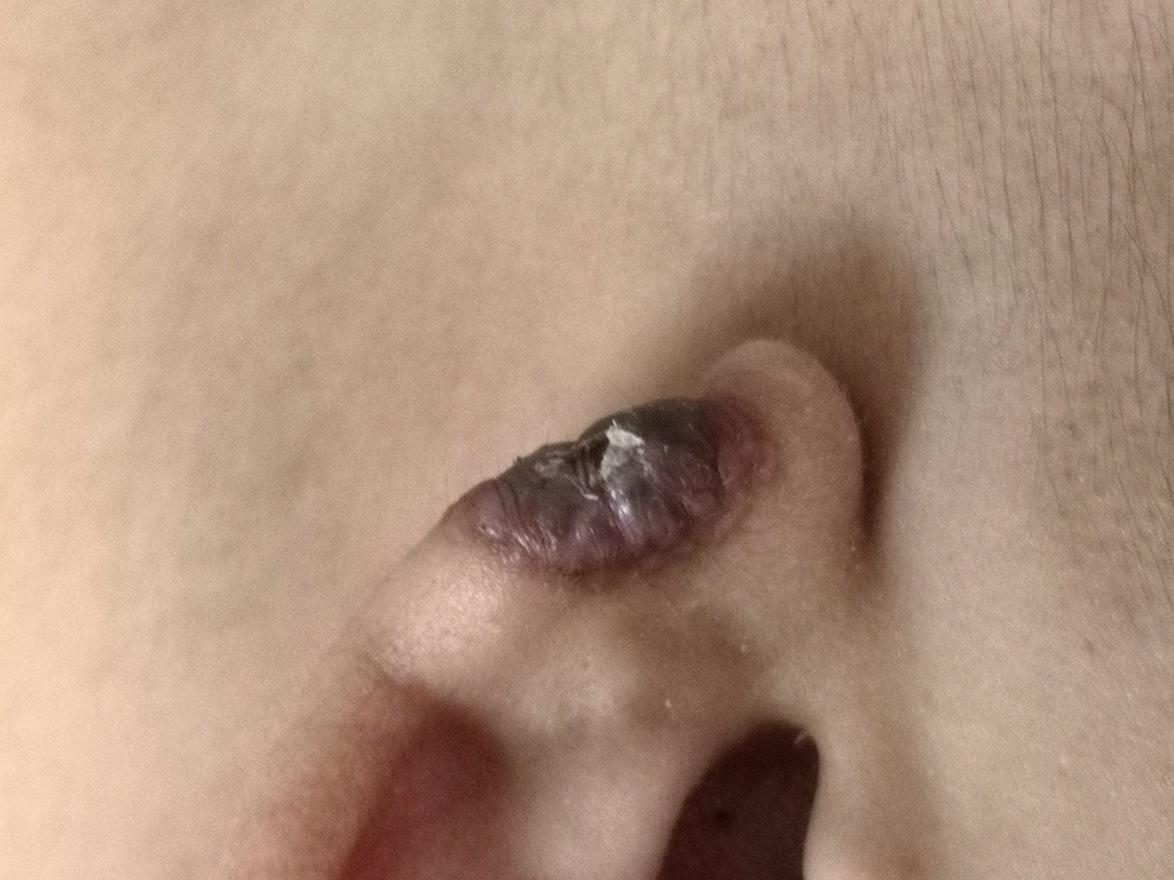 手术切除治疗也可以 #解决皮肤问题专注皮肤美容##纤维瘤