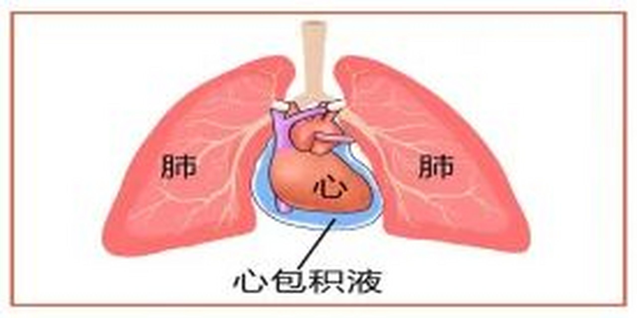 心包积液治疗图片