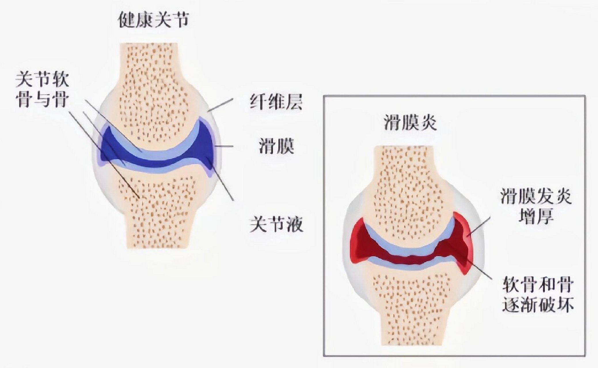 膝关节滑囊位置图图片