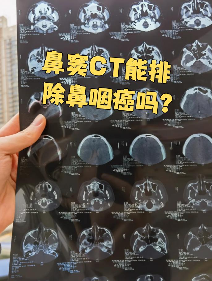 鼻窦ct不能完全排除鼻咽癌