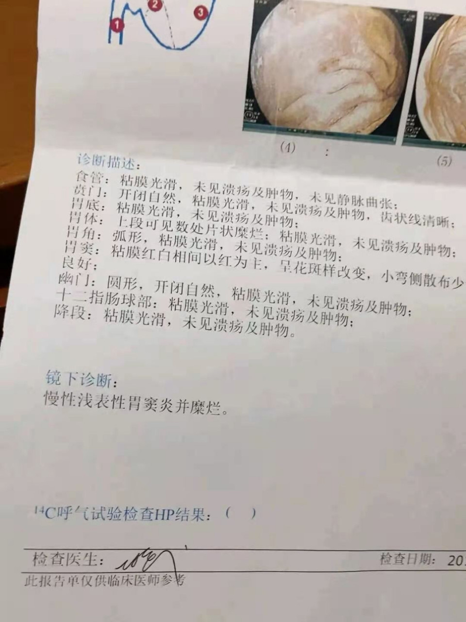 浅表性胃炎伴糜烂四个月了,谁能救救我 	 年前12月份做的胃.