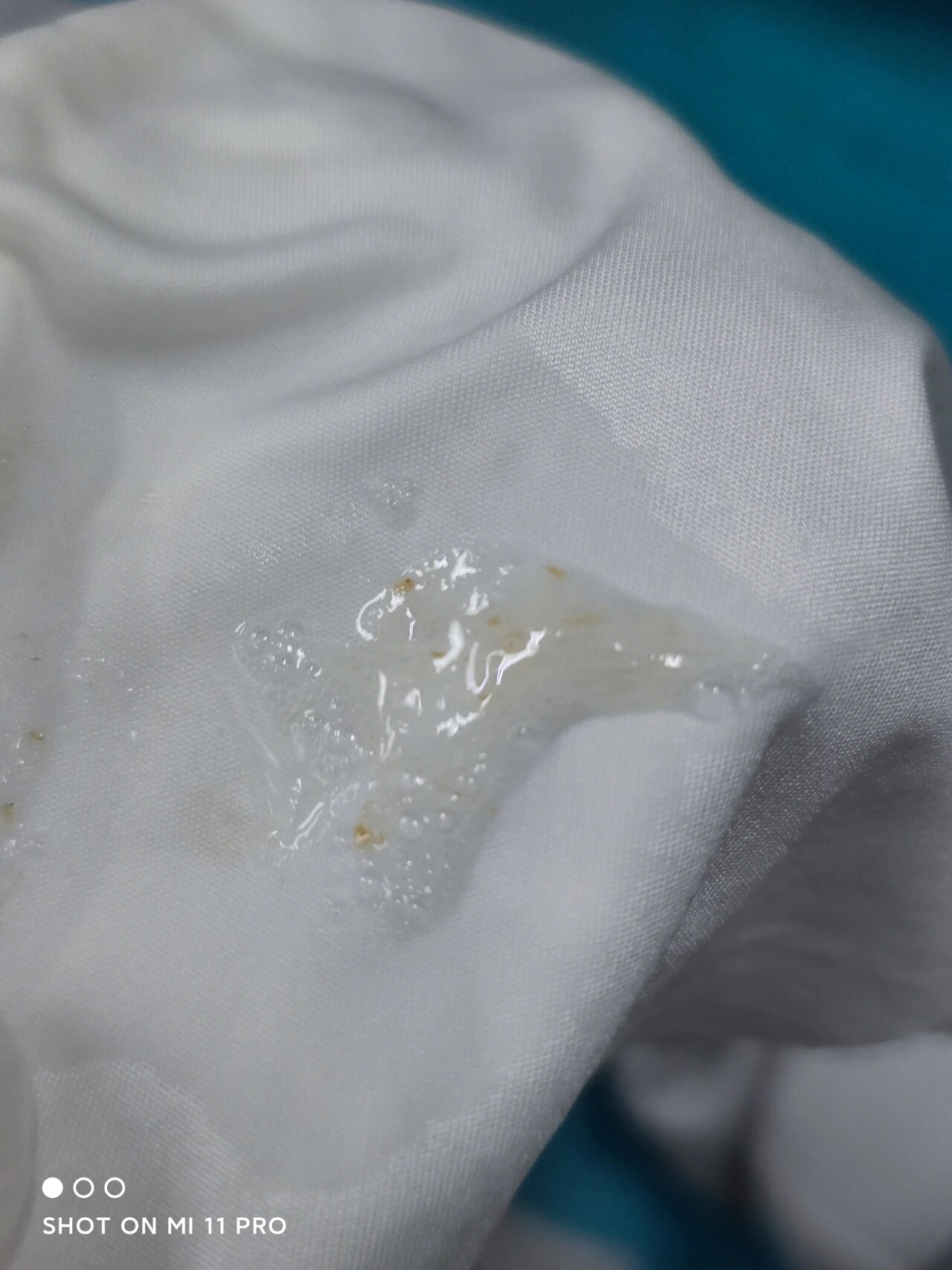 咳白色泡沫痰,怎么治疗?