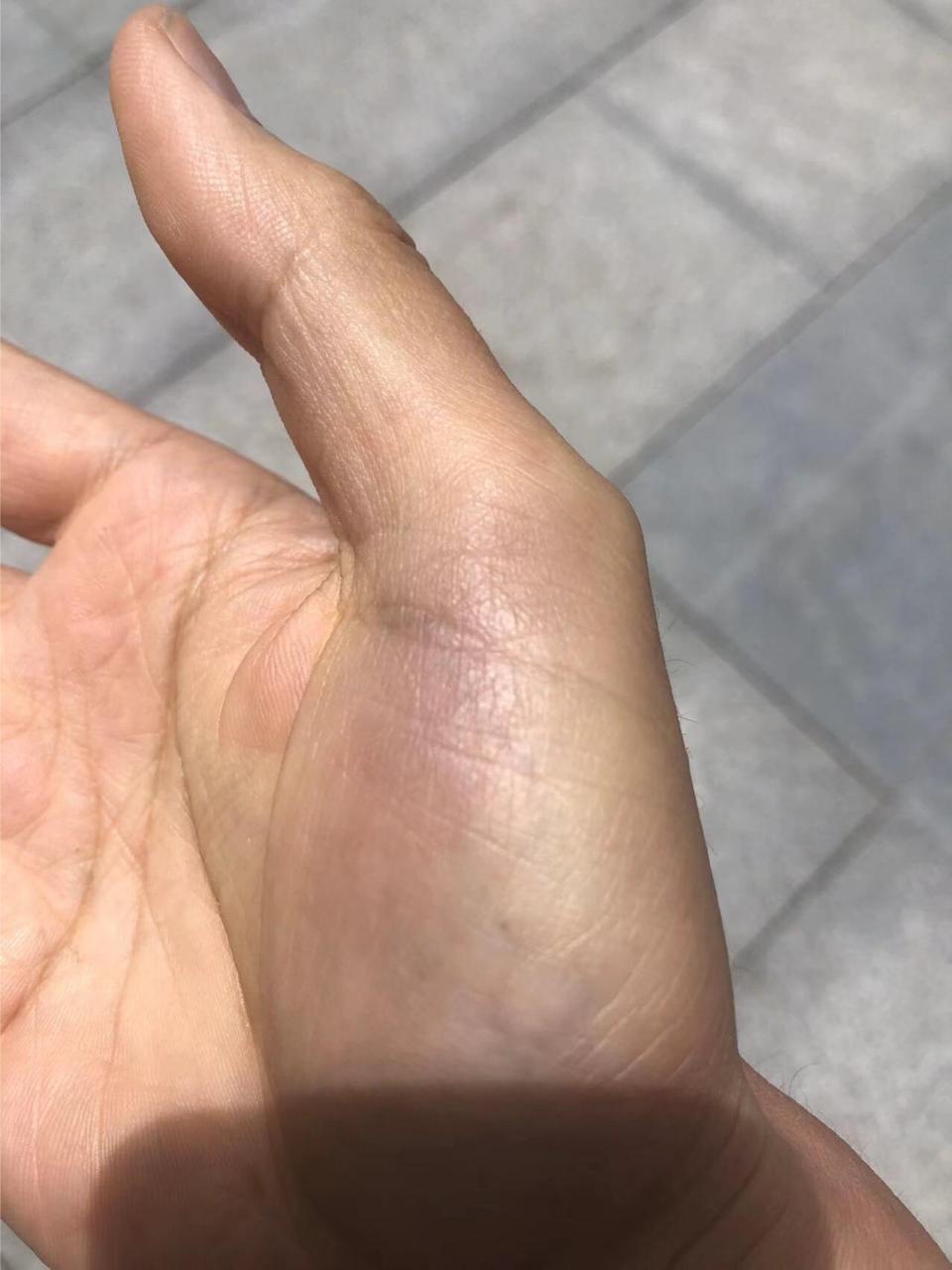 这是血管堵了还是出血了?突然大拇指边上发红,发疼.