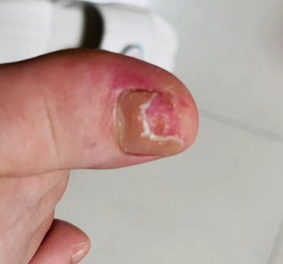 化学刺激:当大脚趾部位频繁接触到有刺激性的物质,比如化学药品后