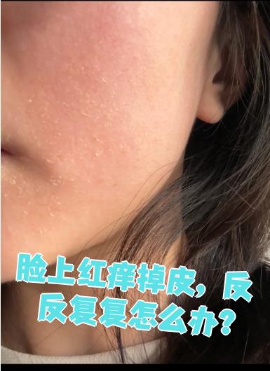 为什么反复过敏了怎么回事百科在线