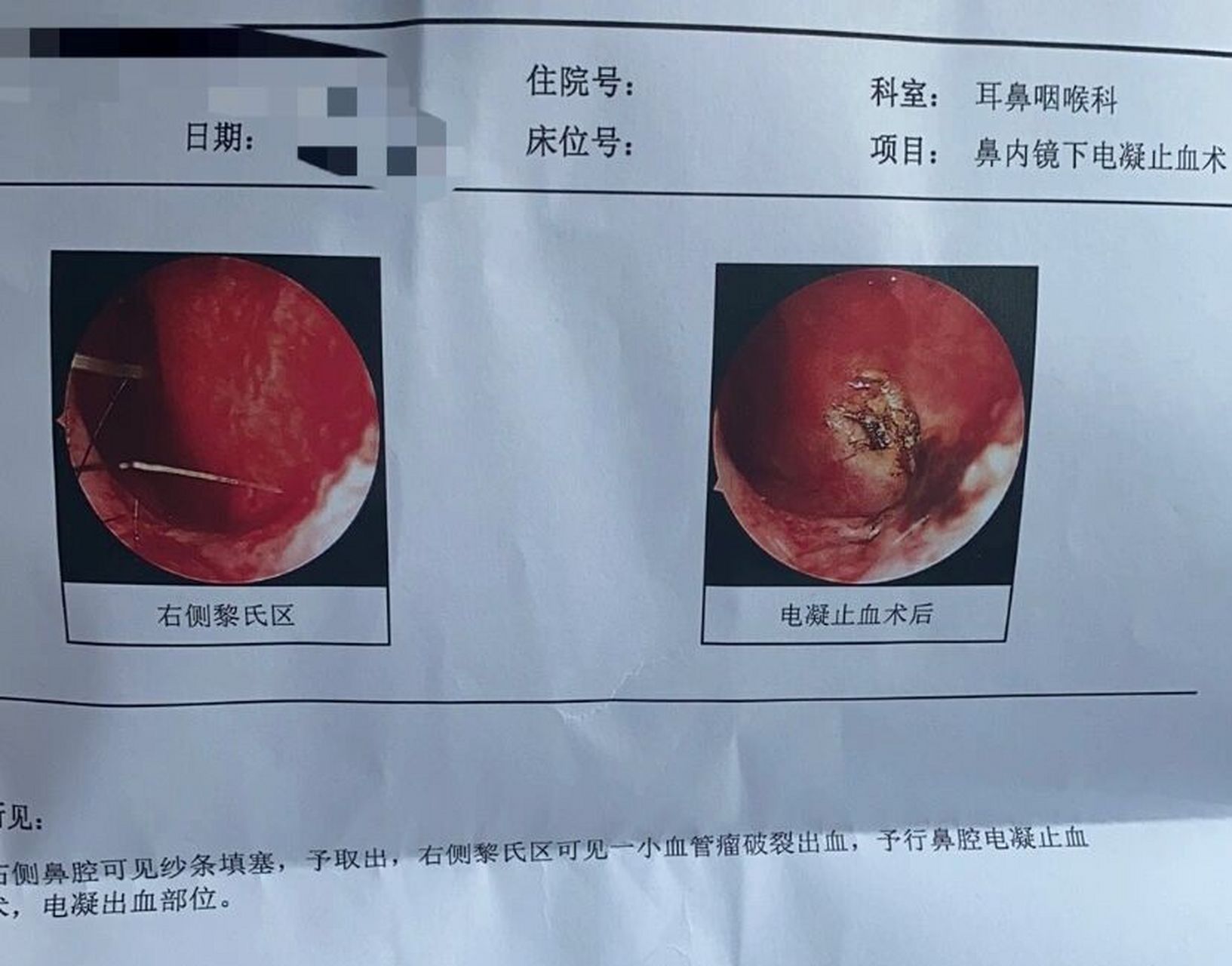 鼻出血电凝手术.虽然喷麻药,没效果阿,电了还是很疼.