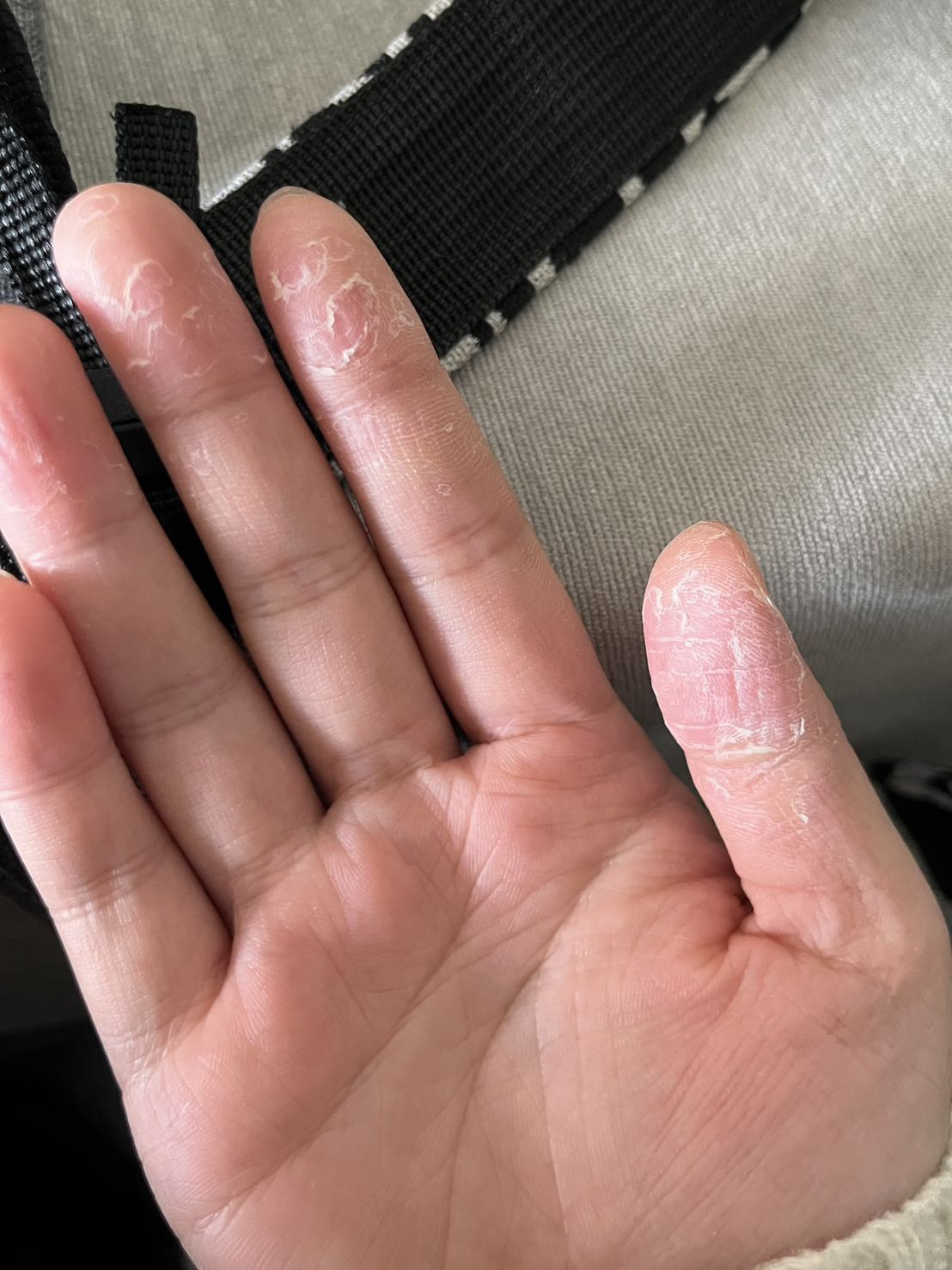 记录我的日常手指脱皮 最近淘宝盲买了一种中药药膏 上周的手如图一二