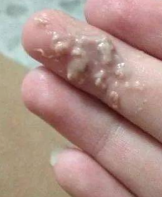 用抗hpv药物后出现豆腐渣样分泌物是否正常,要看具体情况