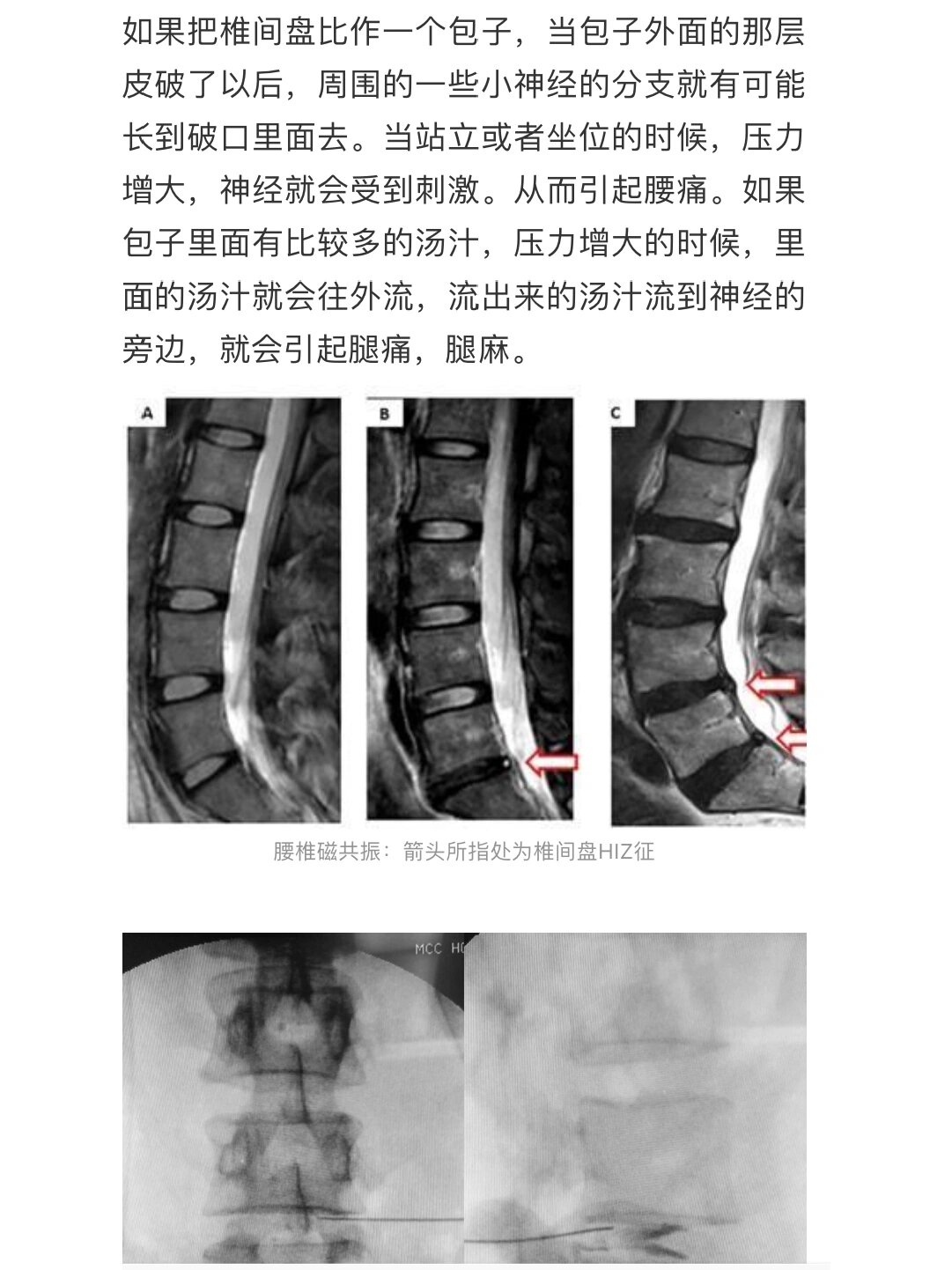 纤维环撕裂之后 我也来做点贡献吧,阳了之后腰痛,纤维环撕裂了,看了