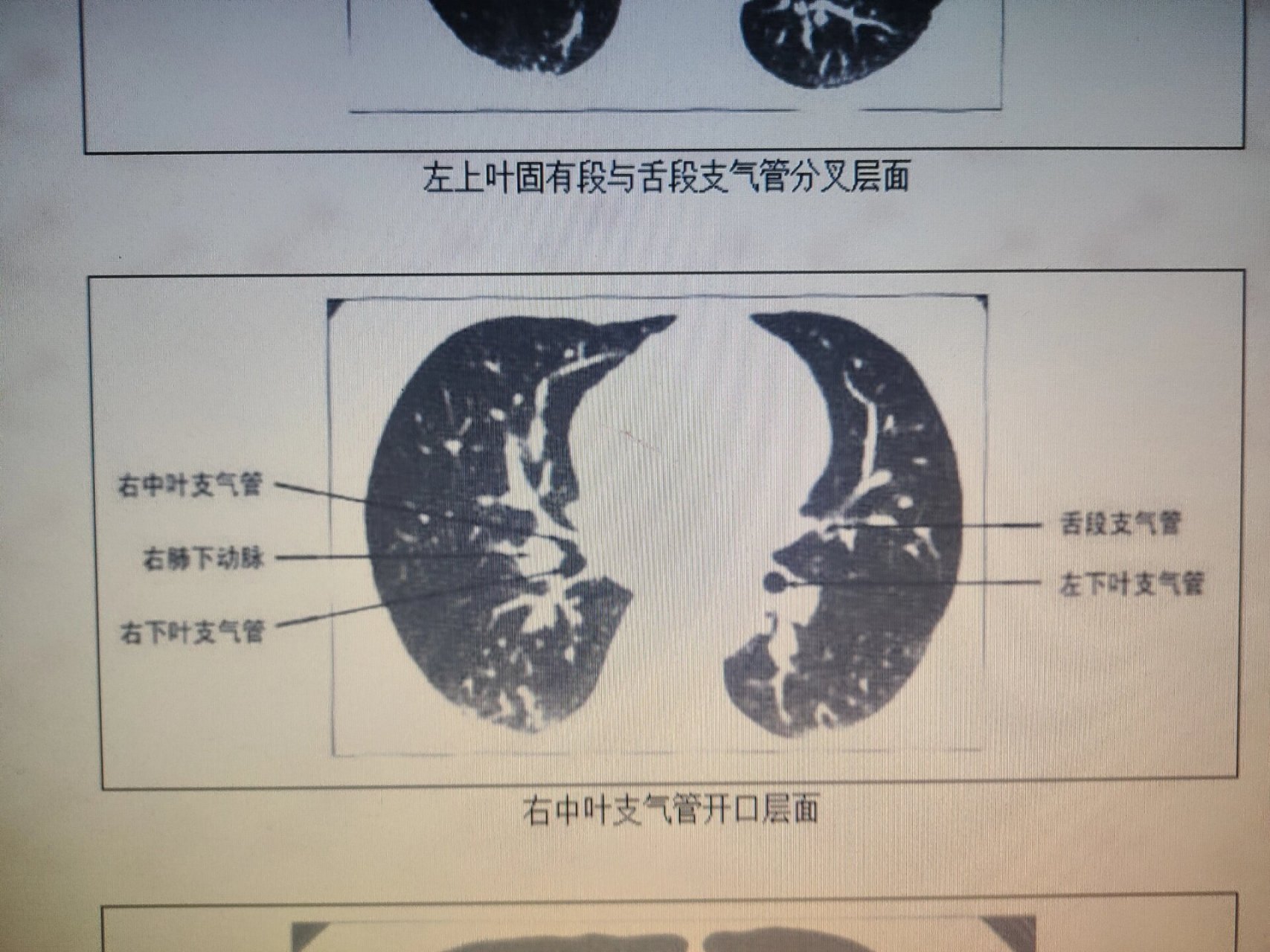 正常肺窗图片图片