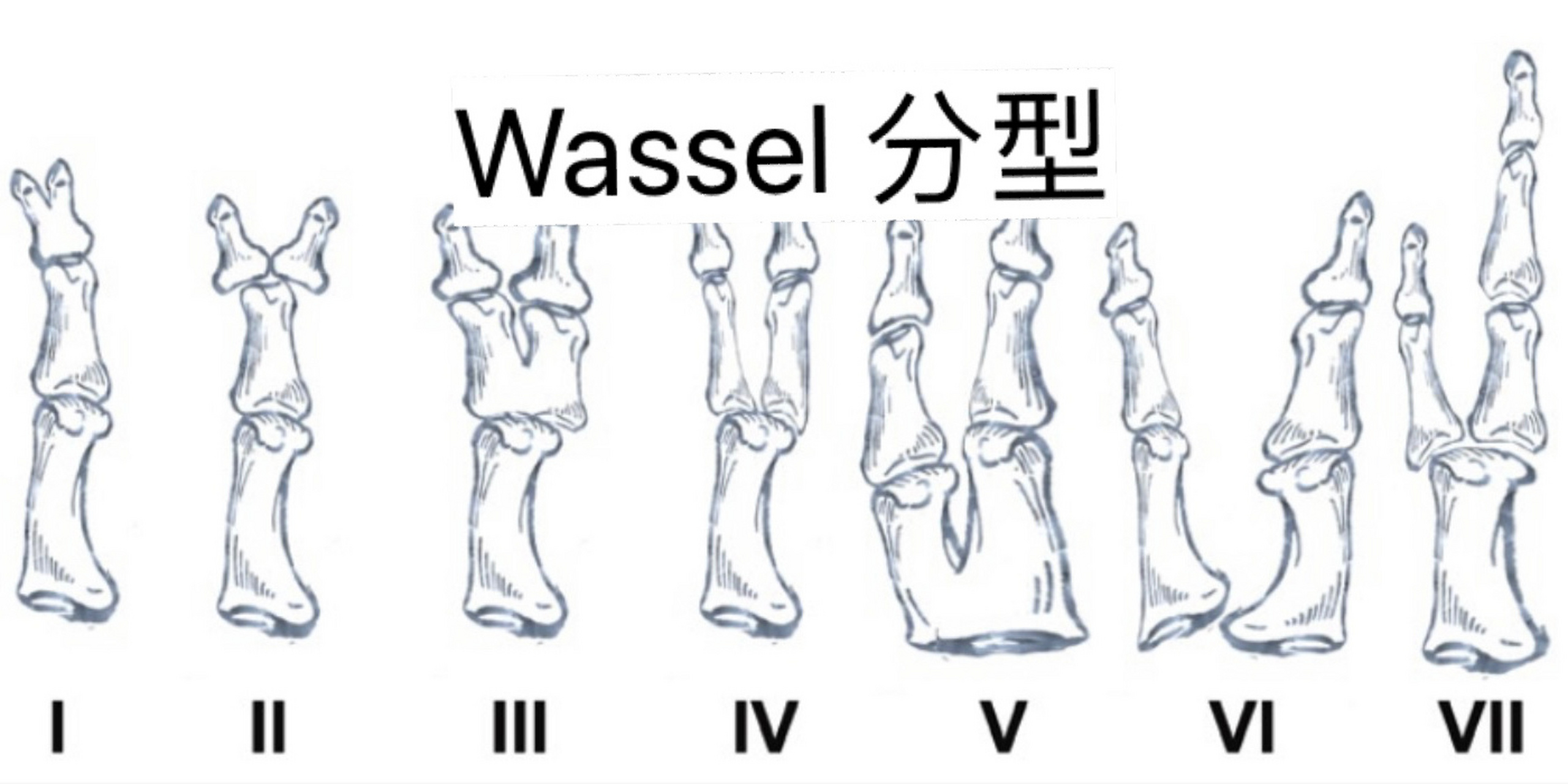 手指畸形种类图片