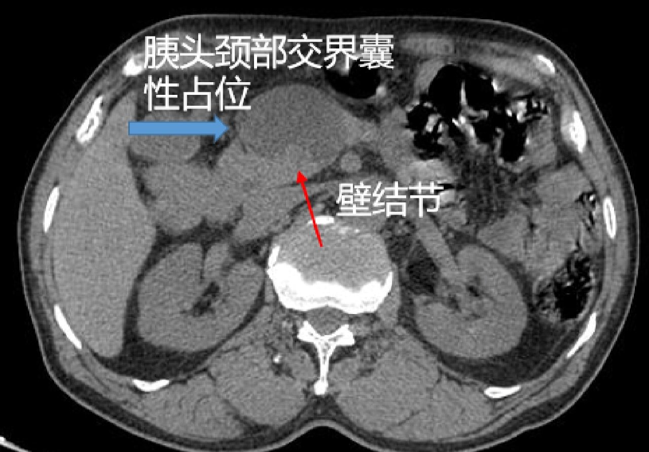 胰腺浆液性囊腺瘤(寡囊型)    ct74胰腺颈部见囊性肿物影,其内可见
