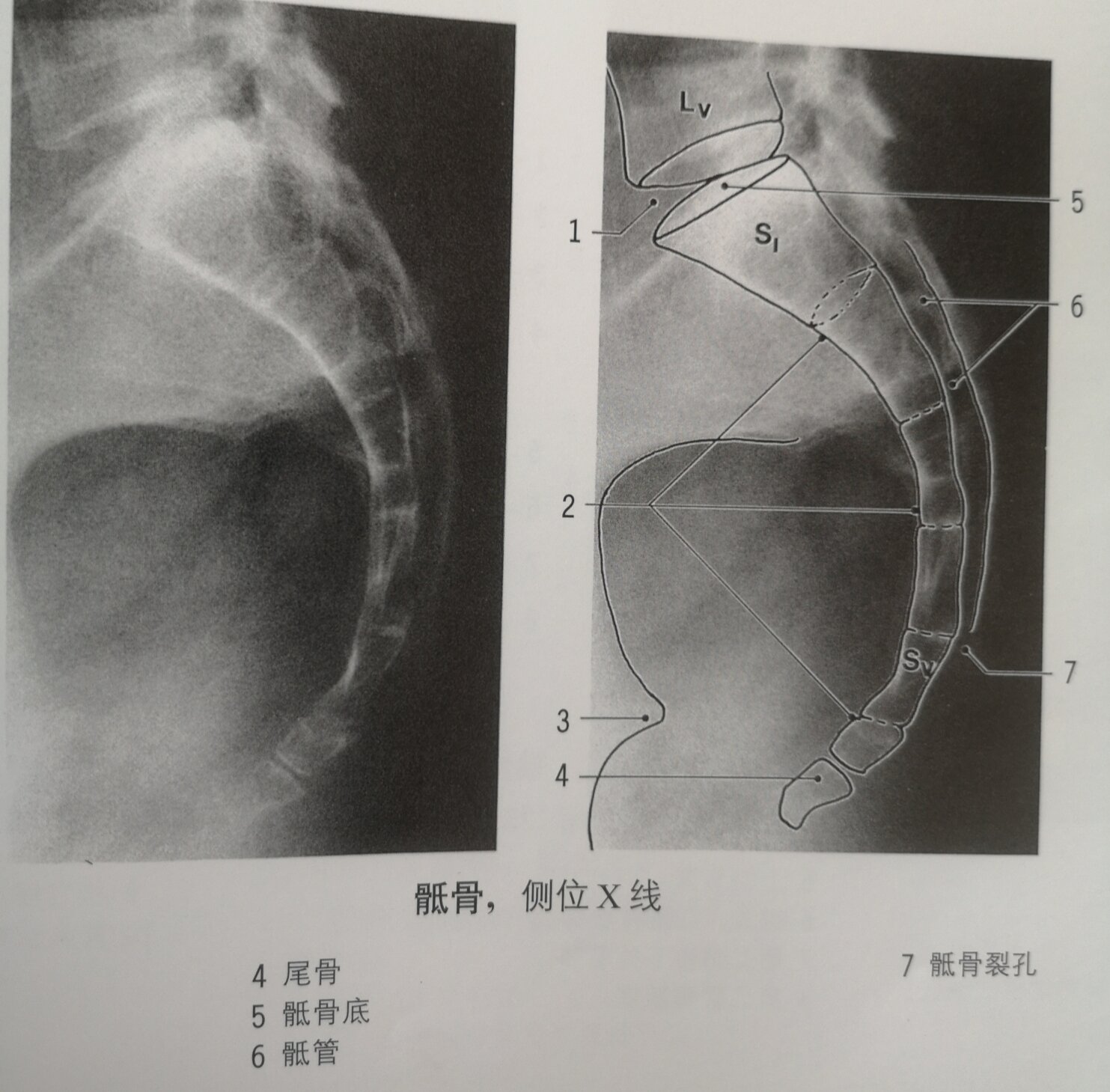 尾骨x光片图片