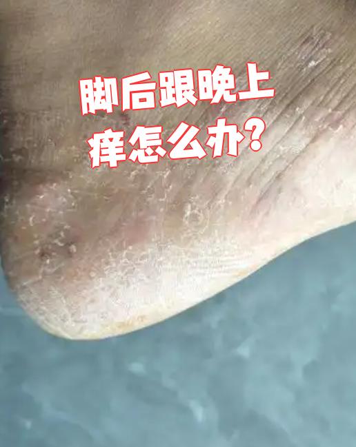 泡完脚后为什么脚会很痒