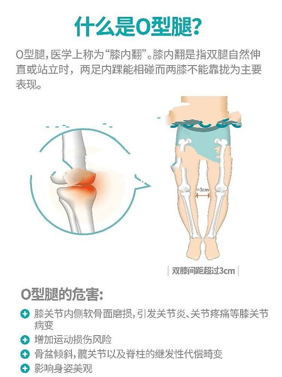 o型腿的原因图片