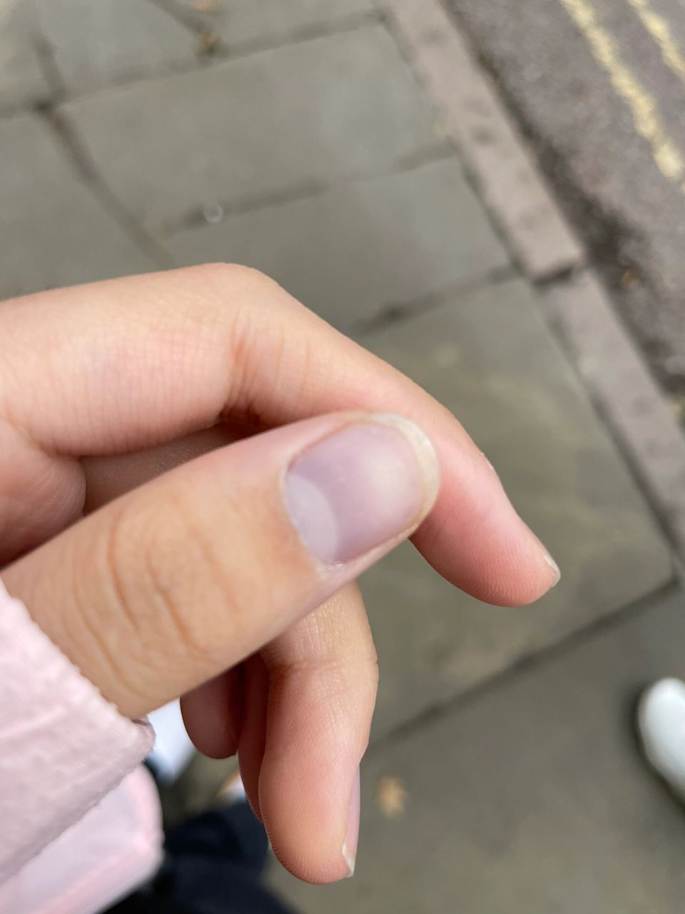 天一冷我的大拇指甲盖就发紫这是为啥