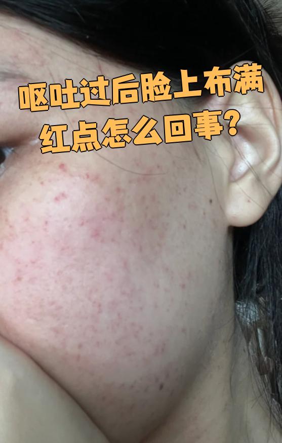 呕吐后脸上出现红点,常见原因有两个:腹部压力升高和过敏反应