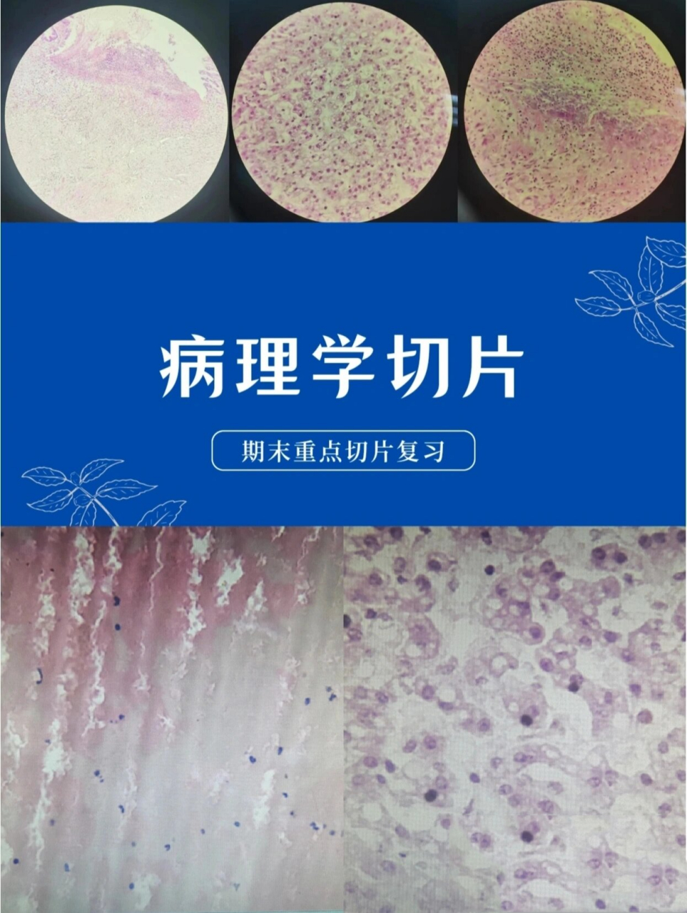 病理学|期末切片复习⑥ 95胃溃疡 镜下描述 ①低倍镜 可见胃粘膜上