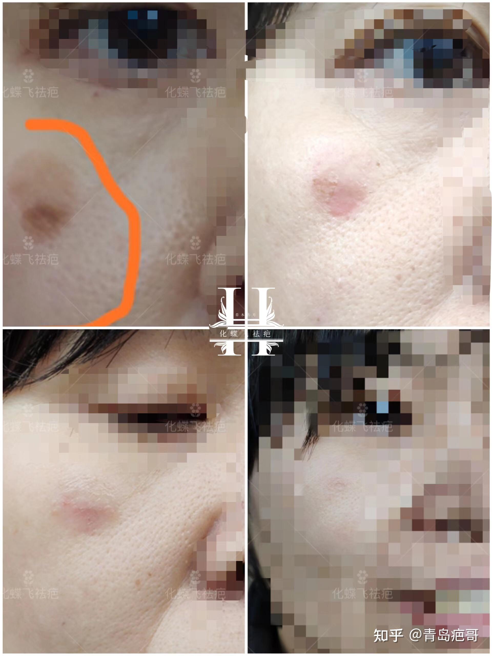很多年的色素沉淀疤痕
