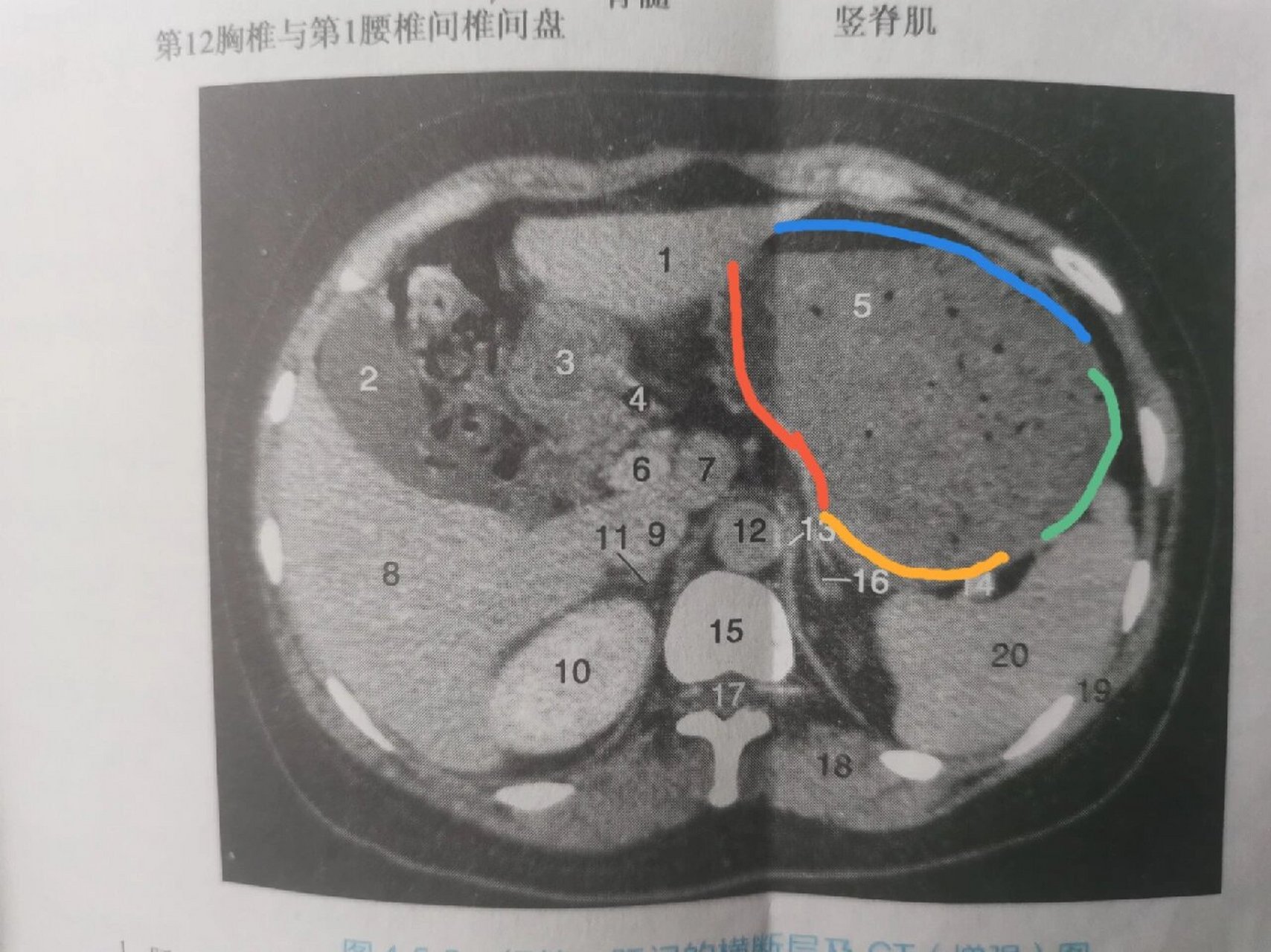 皮革胃CT图片