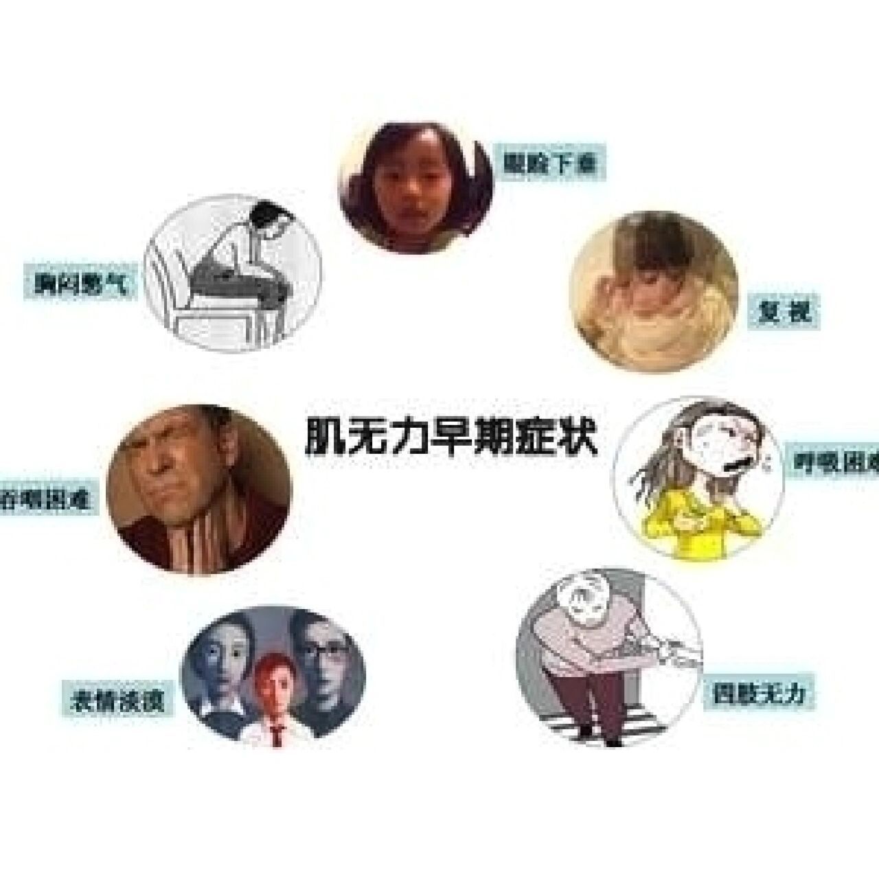 肌营养不良的症状